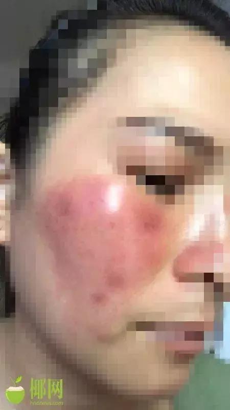 可怕！被“花式”广告诱惑，海口美女用微商面膜后“毁容”～