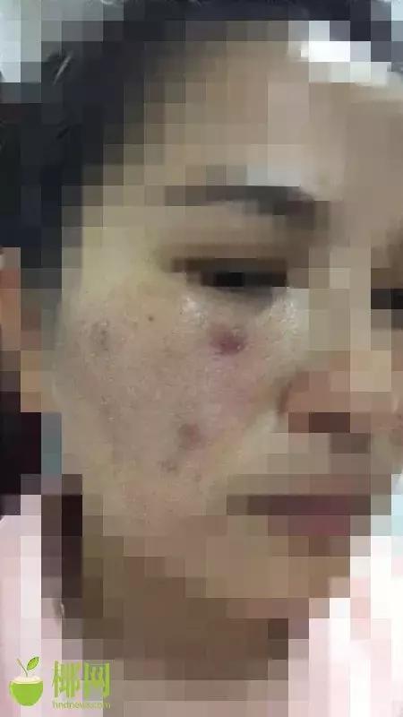 可怕！被“花式”广告诱惑，海口美女用微商面膜后“毁容”～