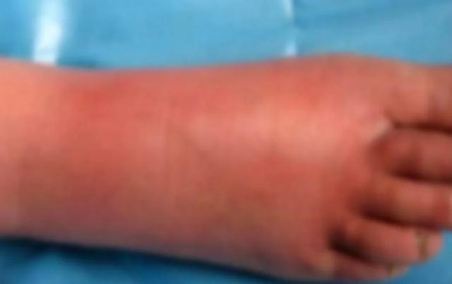 注意！贵阳一女子踩到铁钉没重视，结果差点…… 医生：病死率高，非常危险！