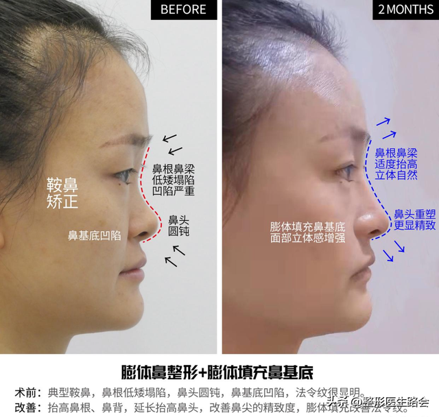 花几万块钱去北京做鼻子,改善面中凹陷,术后闺蜜说“不值”?