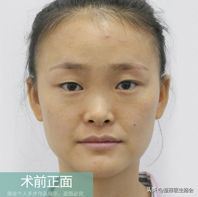 花几万块钱去北京做鼻子,改善面中凹陷,术后闺蜜说“不值”?
