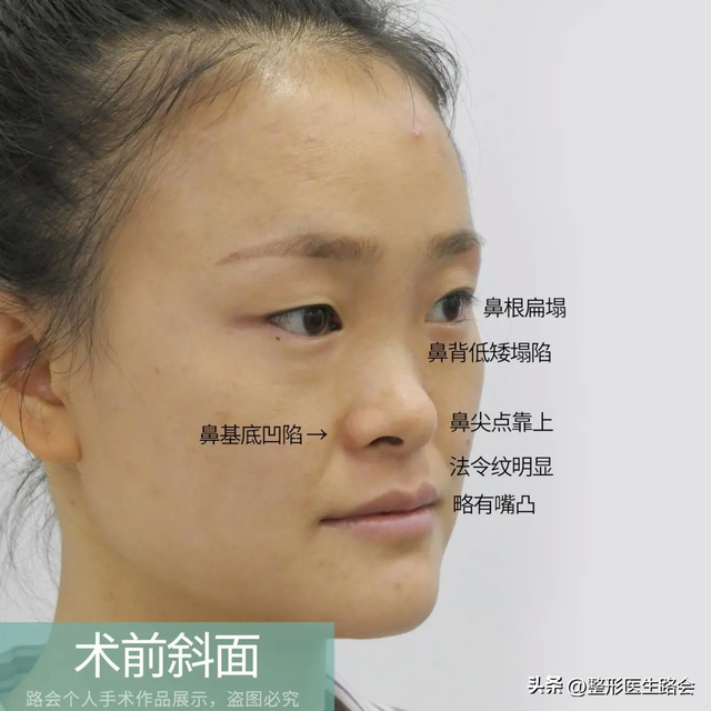 花几万块钱去北京做鼻子,改善面中凹陷,术后闺蜜说“不值”?