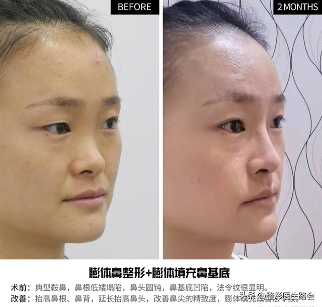 花几万块钱去北京做鼻子,改善面中凹陷,术后闺蜜说“不值”?