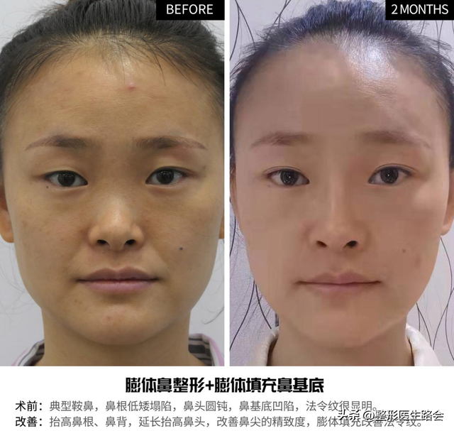 花几万块钱去北京做鼻子,改善面中凹陷,术后闺蜜说“不值”?
