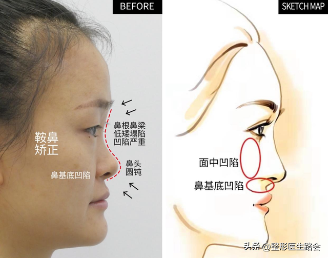 花几万块钱去北京做鼻子,改善面中凹陷,术后闺蜜说“不值”?