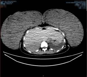 胸逼(女子乳房两年内从B杯→Q杯医生提醒：这种病症恐会影响生命……)