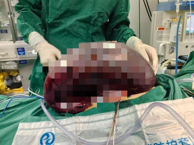 没见过这么粗的！女子腹中掏出1米长“巨蟒”，竟是因为……