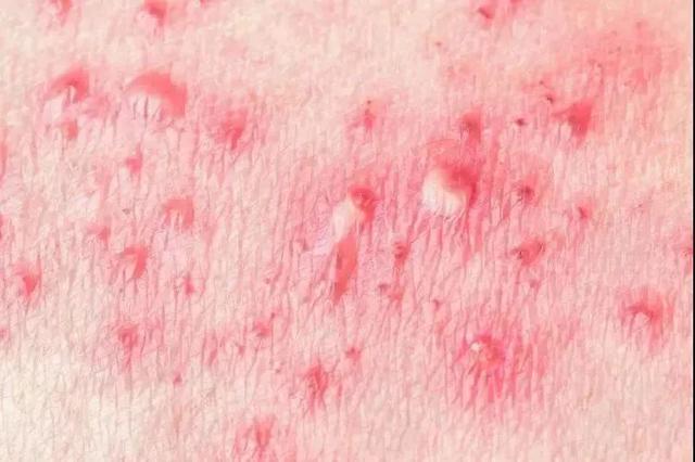 脱衣服的时候，一根纤维扯破了水泡，我痛得大哭