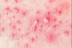 托衣服(脱衣服的时候，一根纤维扯破了水泡，我痛得大哭)