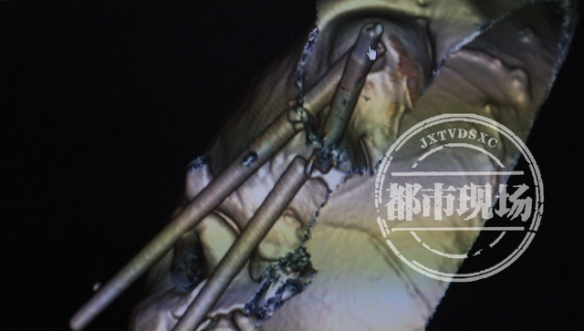 两根筷子直插右眼！一男子跌跌撞撞求医