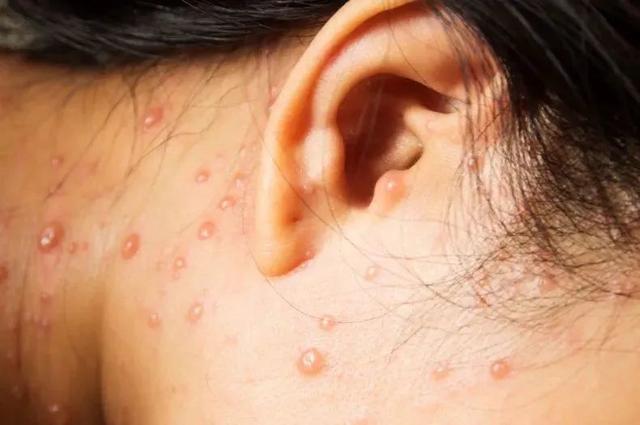 脱衣服的时候，一根纤维扯破了水泡，我痛得大哭