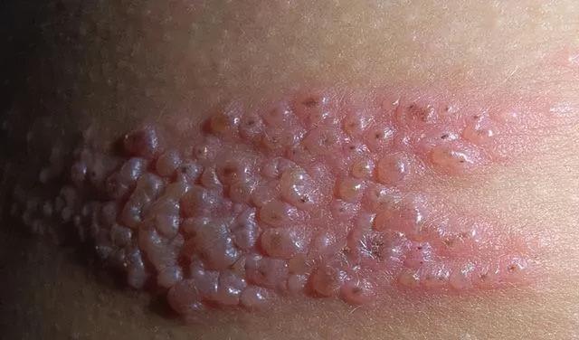 脱衣服的时候，一根纤维扯破了水泡，我痛得大哭