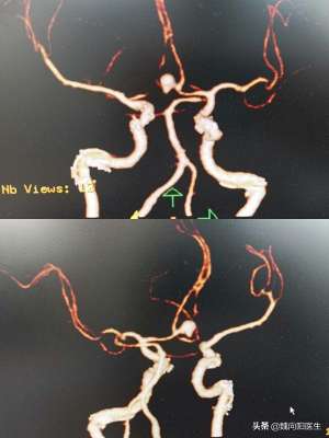 炸弹头(脑子里面炸弹爆了,一脑袋血,为什么在腰上置管放血?)