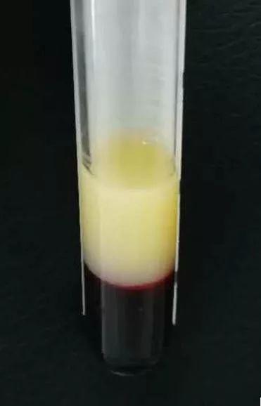 一天一斤白酒,杭州“海量哥”抽出5管“猪油”,差点暴肝!医生:这爱好必须戒