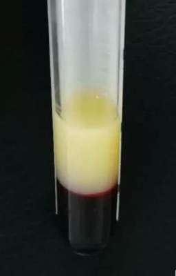 哥也射(一天一斤白酒,杭州“海量哥”抽出5管“猪油”,差点暴肝医生:这爱好必须戒)