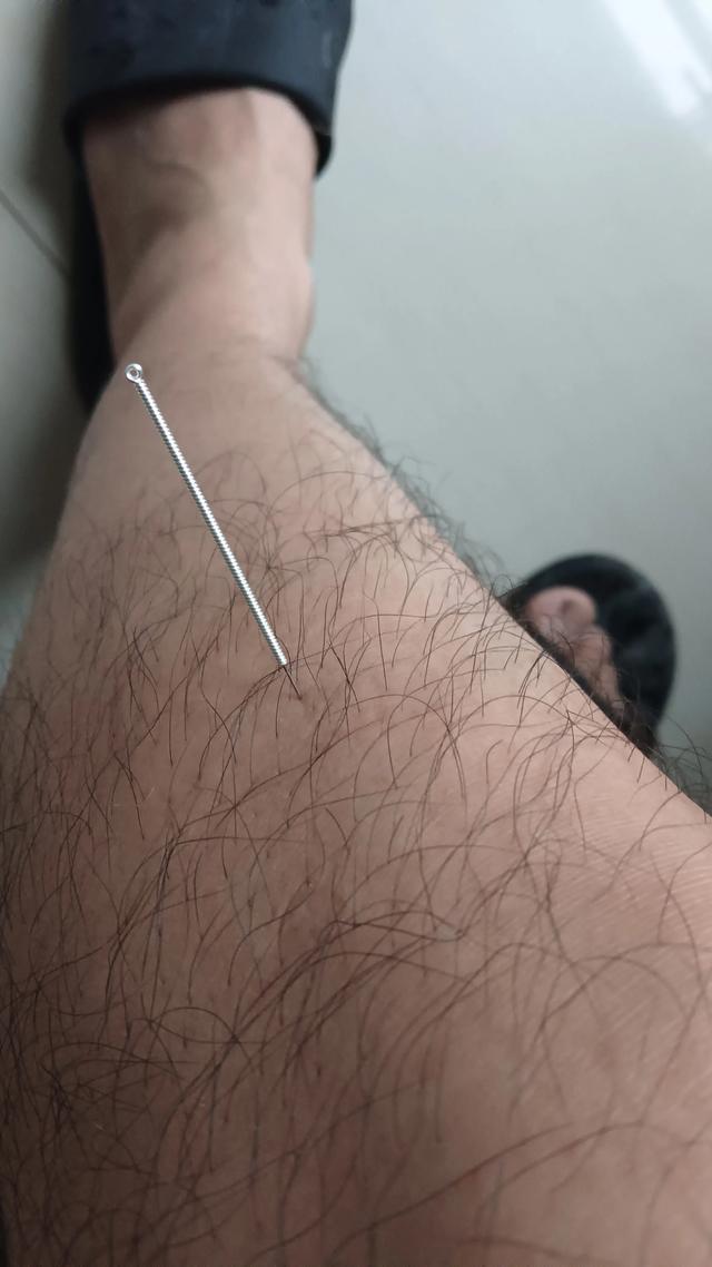 我的针灸二三事之三