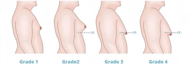 小伙乳房腺体发育，行动会晃，乳晕微创圆梦