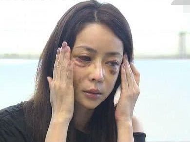 “比基尼王后”王子鱼，遭51岁富豪男友暴打吐血，头骨也骨折太惨