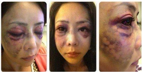 “比基尼王后”王子鱼，遭51岁富豪男友暴打吐血，头骨也骨折太惨