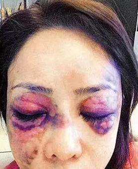 “比基尼王后”王子鱼，遭51岁富豪男友暴打吐血，头骨也骨折太惨