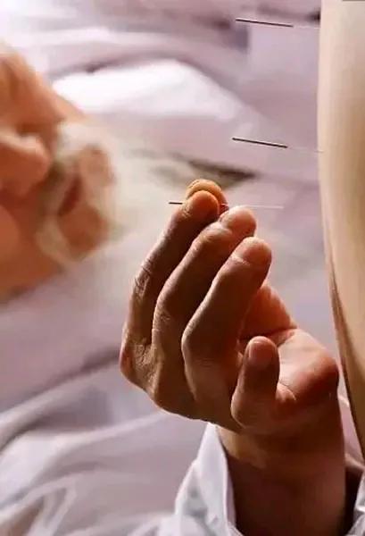 我的针灸二三事之三