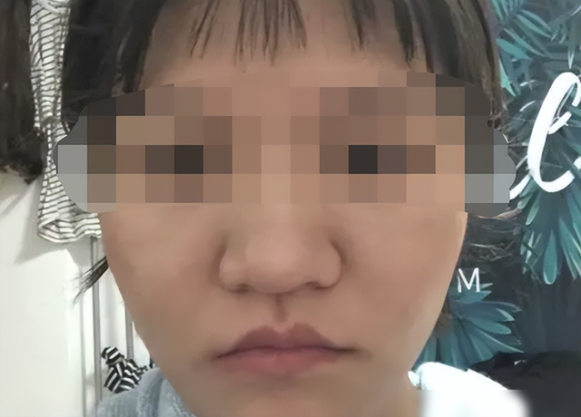“蒜头鼻”对颜值影响有多大？看完这几组对比图后，你就知道了