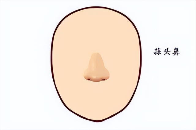 “蒜头鼻”对颜值影响有多大？看完这几组对比图后，你就知道了