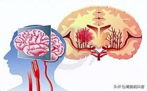 凤凰女主播刘珊玲(脑血管崩溃前有10个信号，千万别等半身不遂才看到)
