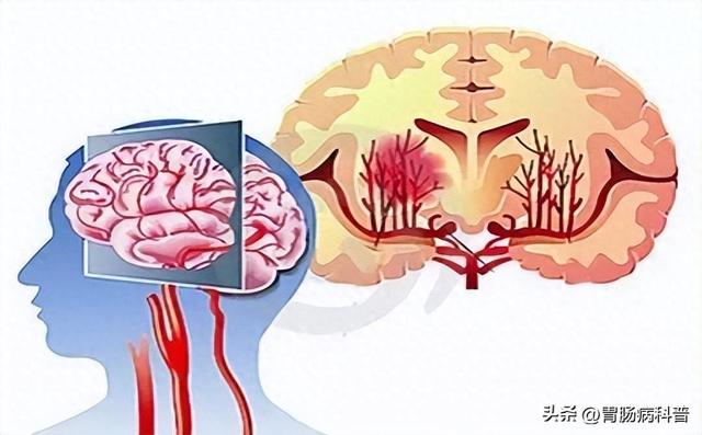 脑血管崩溃前有10个信号，千万别等半身不遂才看到！