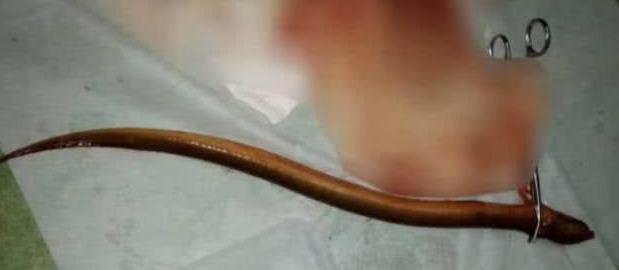 听信“偏方”治肺癌,女子生吞一瓶蛆虫!奇葩偏方还有鳝鱼塞肛门...