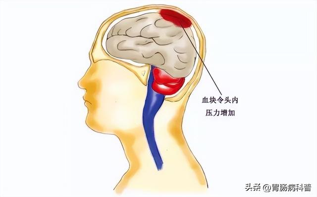 脑血管崩溃前有10个信号，千万别等半身不遂才看到！