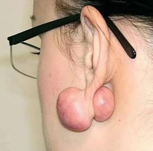 为什么没有人告诉我，打耳洞后会长这种肉疙瘩啊？